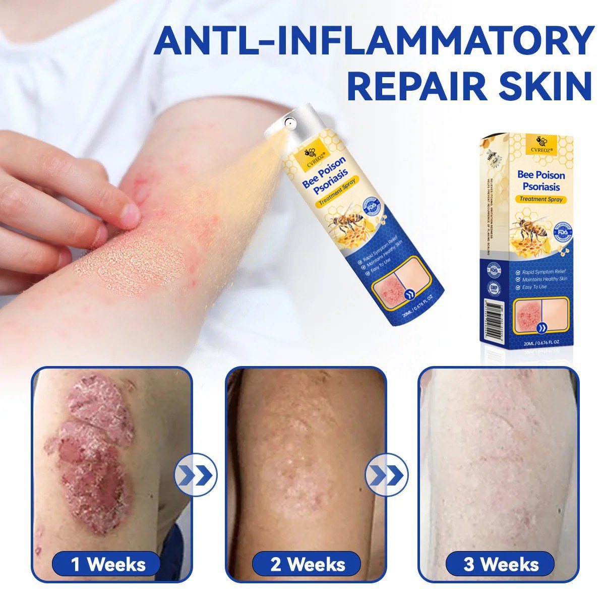 ⭐ CVREOZ® Bee Poison Psoriasis Treatment Spray 🐝 LIMITED OFFER 60% OFF 💛