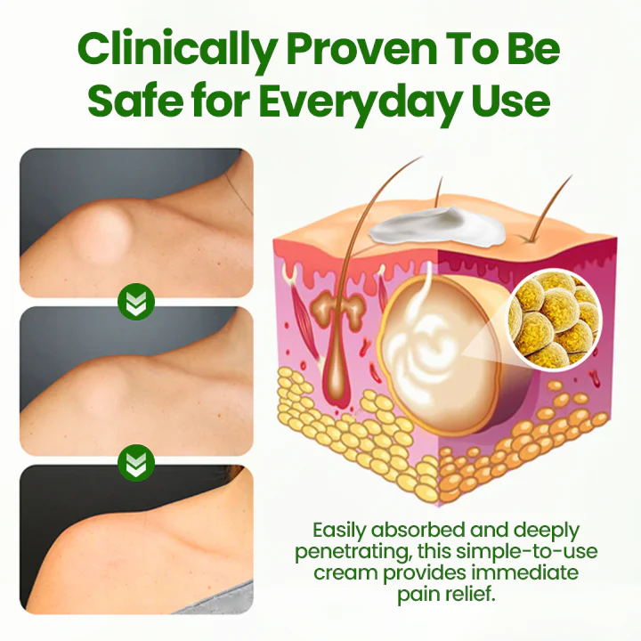 Cvreoz® KnotAway Lipoma Removal Cream