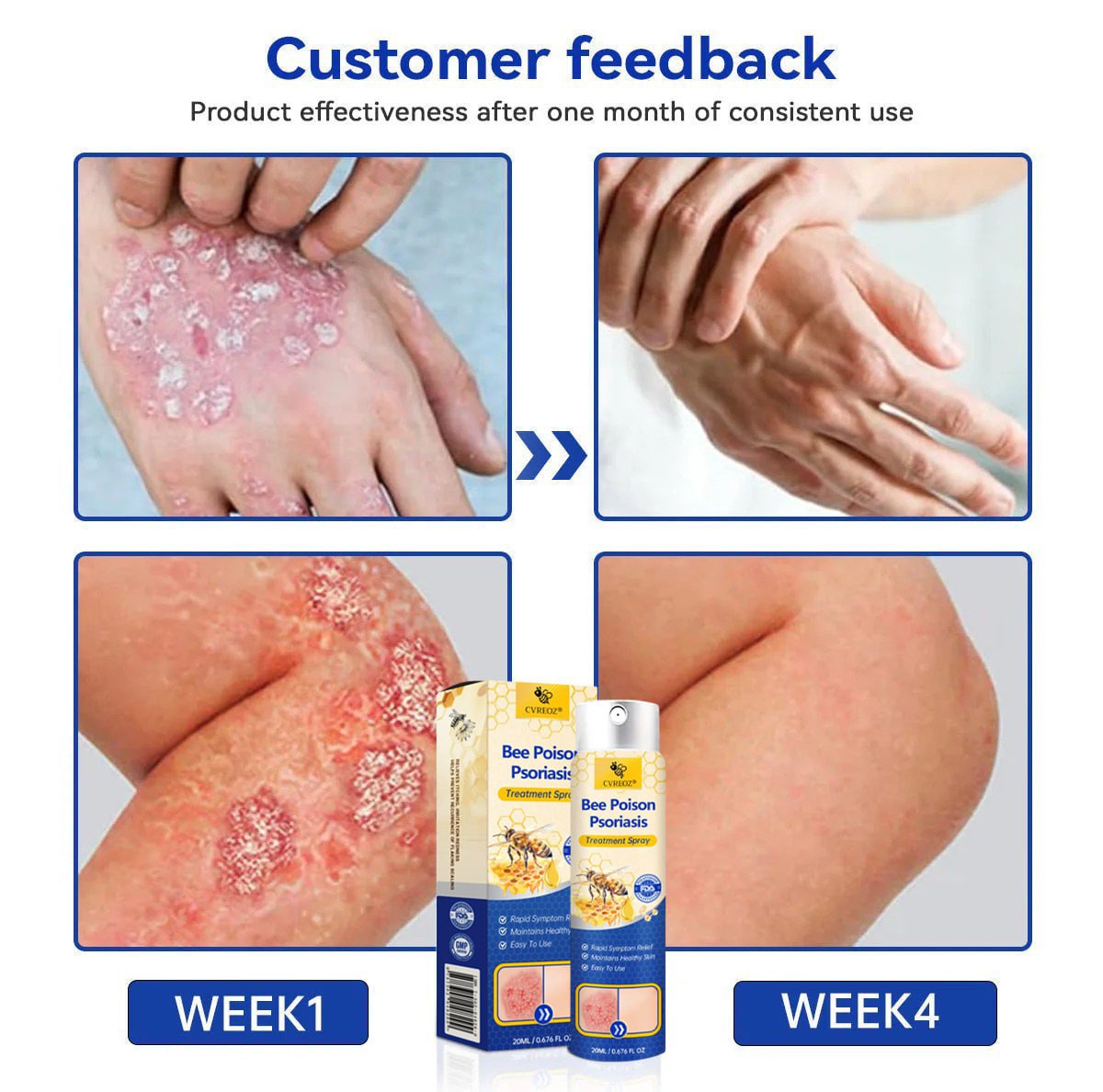 ⭐ CVREOZ® Bee Poison Psoriasis Treatment Spray 🐝 LIMITED OFFER 60% OFF 💛
