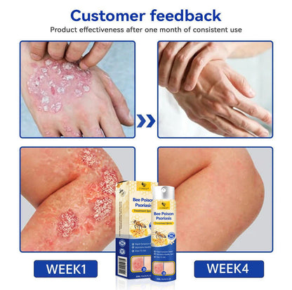 ⭐ CVREOZ® Bee Poison Psoriasis Treatment Spray 🐝 LIMITED OFFER 60% OFF 💛