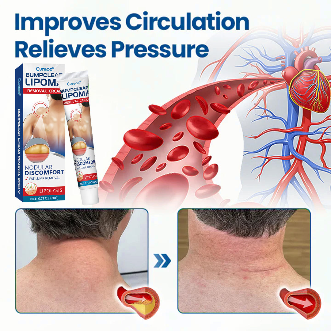 ⏰Last Day Promotion: 60% OFF🔥Cvreoz® Lipoma Removal Cream