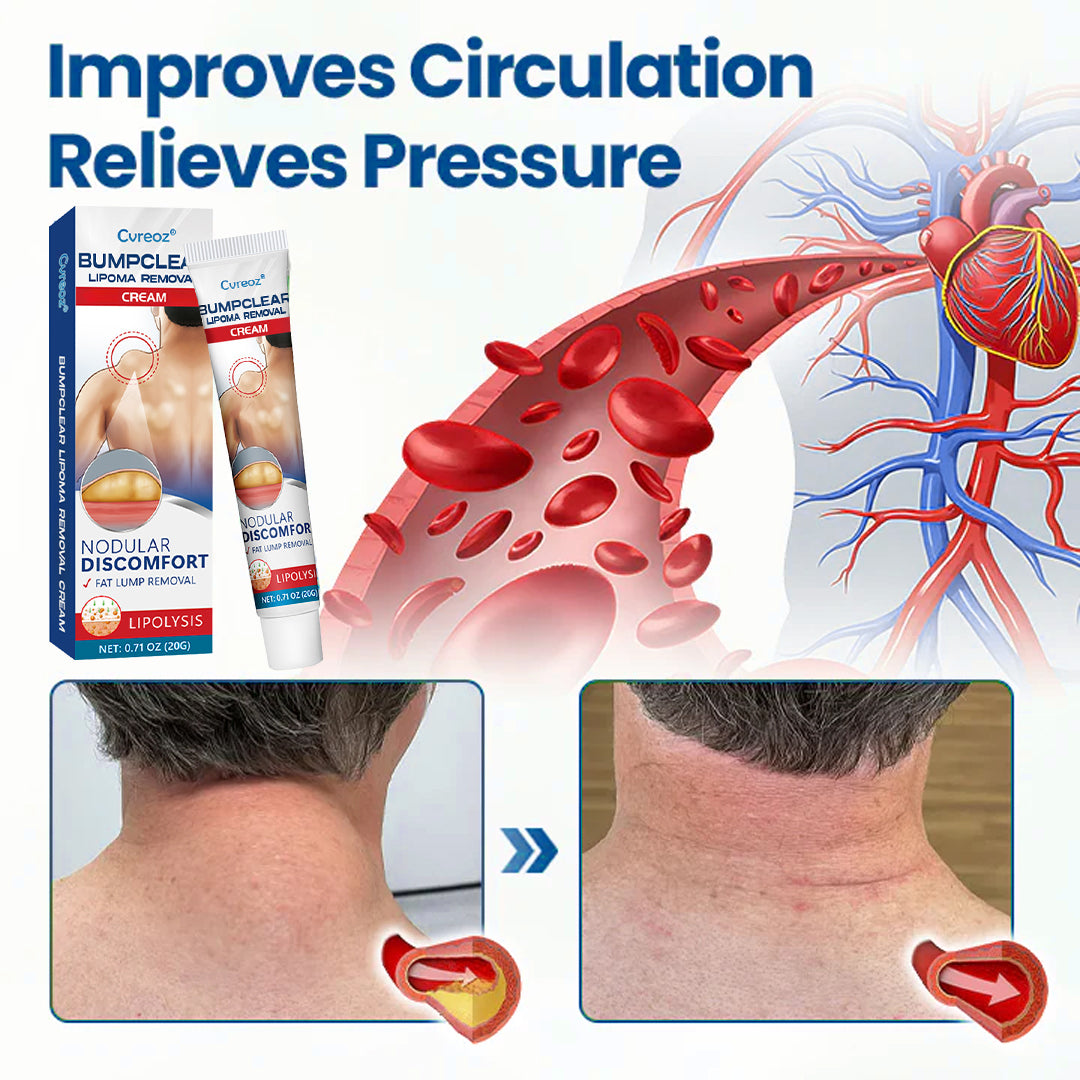 🎉SPECIAL OFFER: 60% OFF This Today Only!🔥Cvreoz® Lipoma Removal Cream