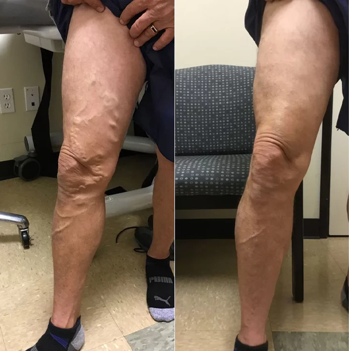 ⏰Last Day Promotion: 60% OFF🔥 Cvreoz® VeinGuard Herbal Spray