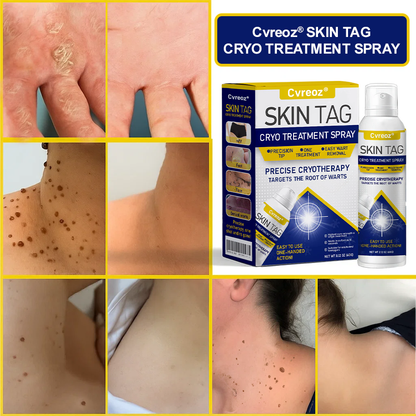 ⏰Last Day Promotion: 60% OFF🔥 Cvreoz® Skin Tag Cryo Treatment Spray