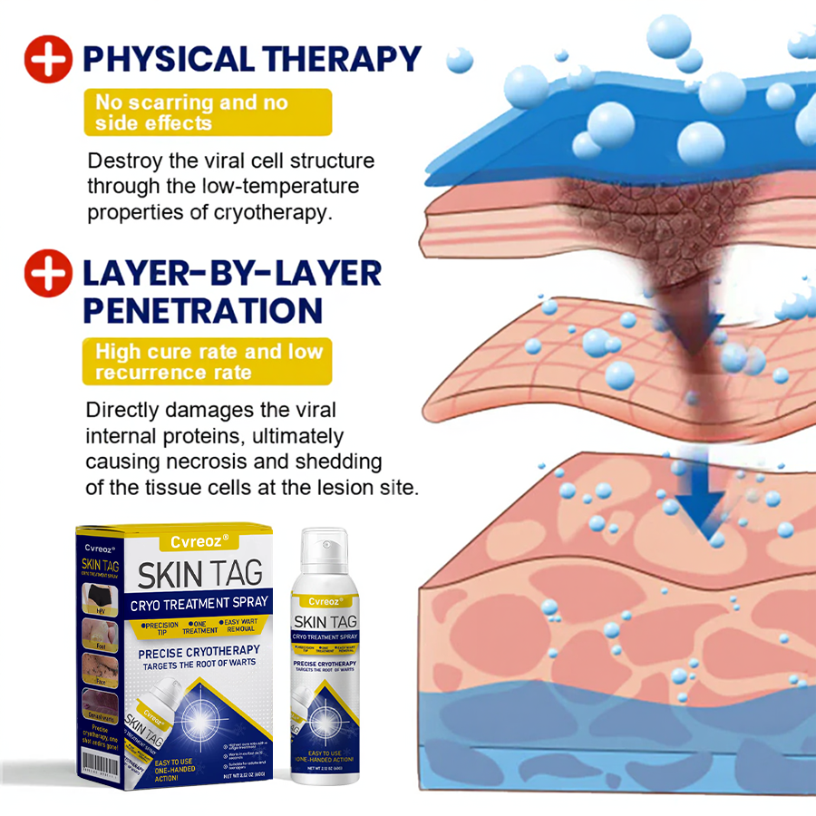 ⏰Last Day Promotion: 60% OFF🔥 Cvreoz® Skin Tag Cryo Treatment Spray