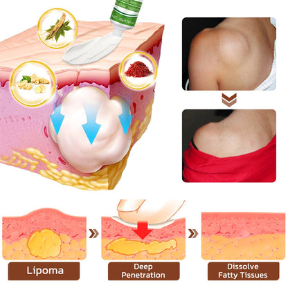 ⏰Last Day Promotion: 60% OFF🔥 Cvreoz® LipomaCure Soothing Ointment