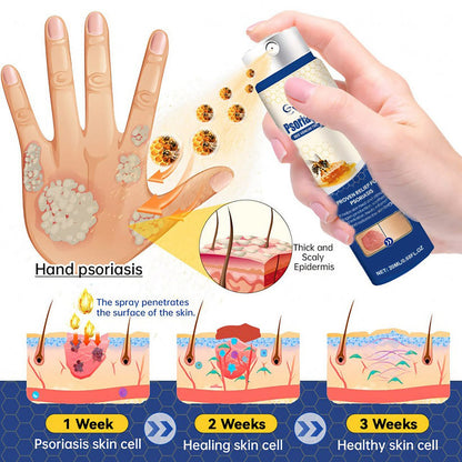 Cvreoz® Psoriasis Cure Bee Venom Treatment Spray 🔥NEWEST VERSION: SALE 60% OFF🐝