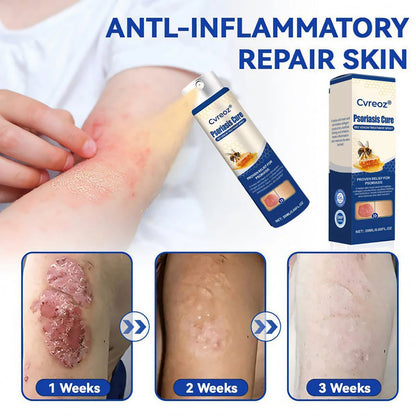 Cvreoz® Psoriasis Cure Bee Venom Treatment Spray 🔥NEWEST VERSION: SALE 60% OFF🐝