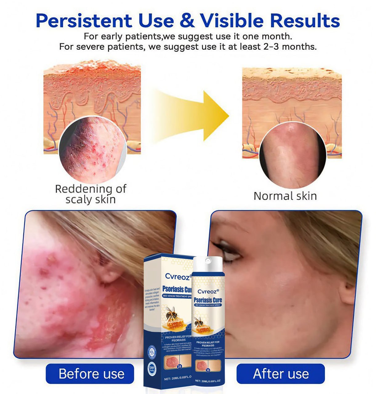 Cvreoz® Psoriasis Cure Bee Venom Treatment Spray 🔥NEWEST VERSION: SALE 60% OFF🐝