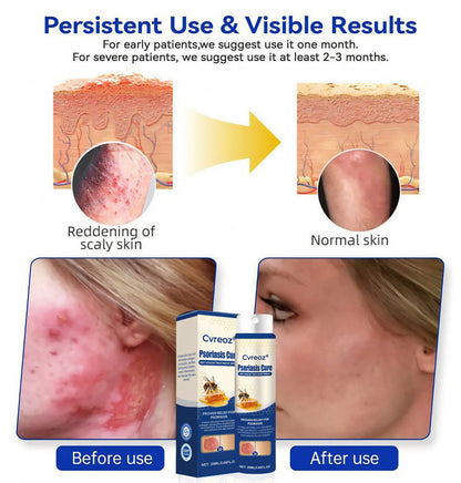 Cvreoz® Psoriasis Cure Bee Venom Treatment Spray 🔥NEWEST VERSION: SALE 60% OFF🐝