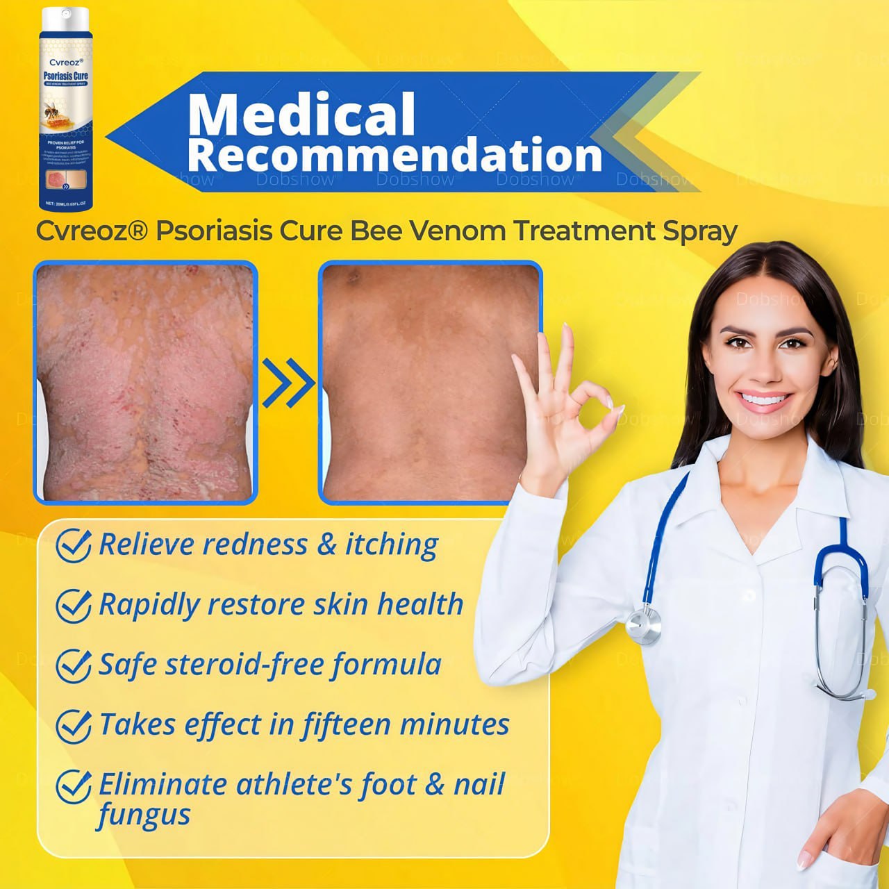 Cvreoz® Psoriasis Cure Bee Venom Treatment Spray 🔥NEWEST VERSION: SALE 60% OFF🐝